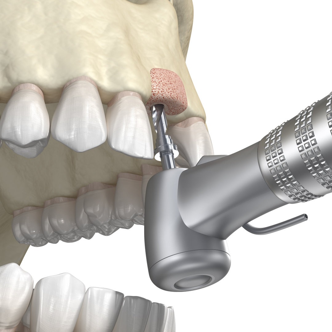 chirurgia-dentale-innesto-osseo