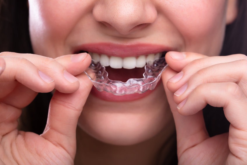 Scopri di più sull'articolo Disallineamento dentale: che cos’è, in cosa consiste e come superarlo con gli allineatori ortodontici invisibili