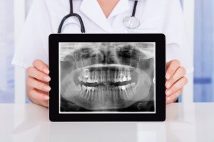 radiografia ai denti
